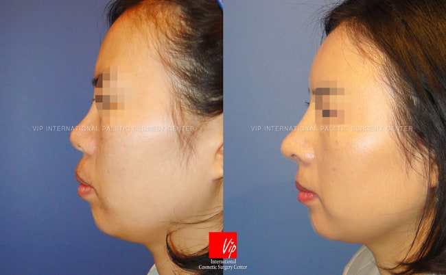 upturned nose caused by silicon implant - Revised rib carilage rhinoplasty  > Before & After Photo