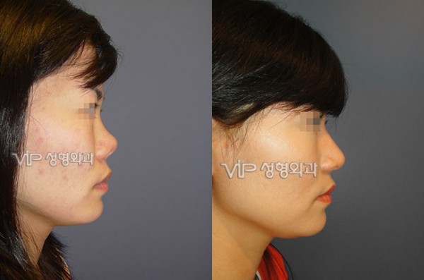 Upturned nose due to silicone contraction - Revision with Rib cartilage >  Before & After Photo
