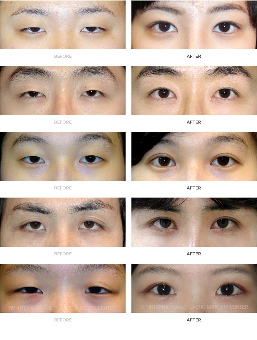korean natural double eyelid