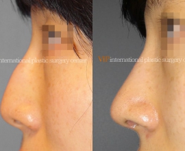 Nose bridge correction