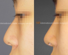 Nose bridge correction