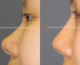 Bulbous nose rhinoplasty