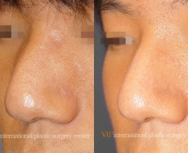 Wide nasal bone reduction rhinoplasty