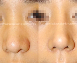 Wide nasal bone reduction rhinoplasty