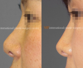 Revision rhinoplasty – Tip correction