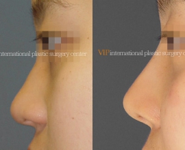 Septal cartilage rhinoplasty