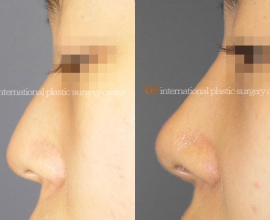 Rib cartilage rhinoplasty