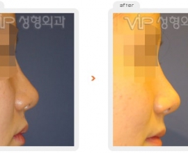 Rib cartilage rhinoplasty