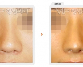 Rib cartilage rhinoplasty