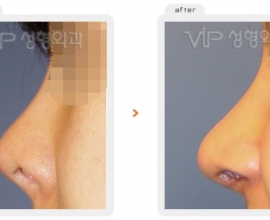 Rib cartilage rhinoplasty