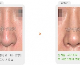 Revision rhinoplasty – Silicone showing nose