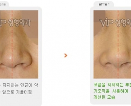 Revision rhinoplasty – Droopy tip