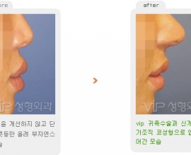 Revision rhinoplasty – Protruded mouth