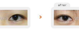 Non-incision double eyelid surgery