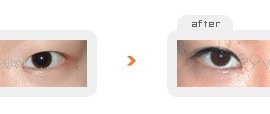 Non-incision double eyelid surgery