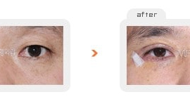 Upper & Lower blepharoplasty