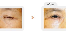 Upper & Lower blepharoplasty