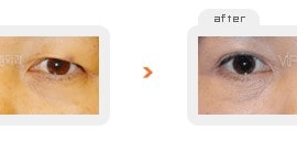 Upper & Lower blepharoplasty