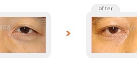 Upper & Lower blepharoplasty