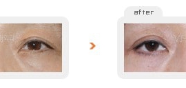 Upper & Lower blepharoplasty