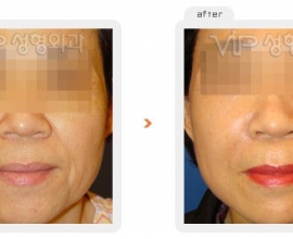 Wrinkle improvement surgery