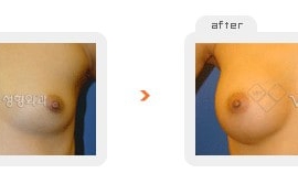 Breast augmentation