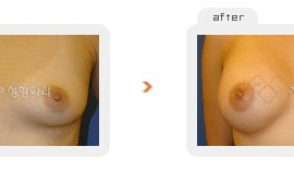 Breast augmentation