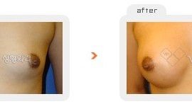 Breast augmentation