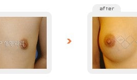 Breast augmentation