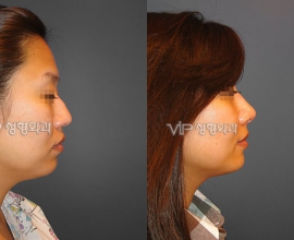 Septal cartilage rhinoplasty