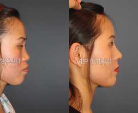 VIP Harmony rhinoplasty