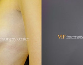 Breast surgery