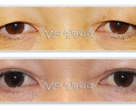 Upper blepharoplasty