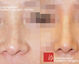 Deviated nose correction