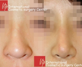 Deviated nose correction