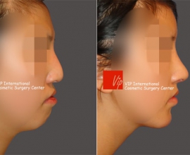 Humped nose correction (protruded mouth improvement as well)- Rib cart…