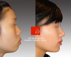 VIP Harmony rhinoplasty ( small, upturned & protruded mouth correction…