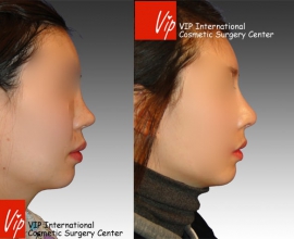 Silicone nose revision – Rib cartilage rhinoplasty