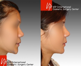 Septal cartilage rhinoplasty – Wide nasal bone reduction & Alar base r…