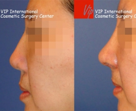 Cleft lip correction – Rib cartilage rhinoplasty