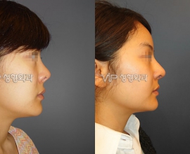 Revision of short nose – Rib cartilage rhinoplasty