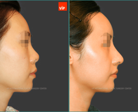 Rib cartilage rhinoplasty, Mid face augmentation, Fat grafting