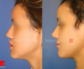 Rib cartilage rhinoplasty after car accident trauma