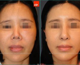 Revision rhinoplasty – Rib cartilage rhinoplasty with mid face augmentation