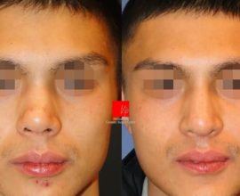 Revision rhinoplasty – Septal deviation