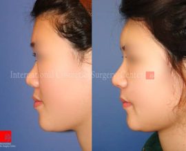 Rib cartilage rhinoplasty with Mid face augmentation