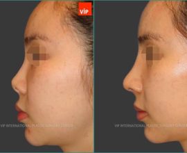 Rib cartilage rhinoplasty-silicone infection