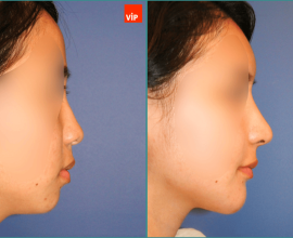 Autologous Rib Cartilage Rhinoplasty, Fat Grafting, Genioplasty