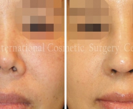 Harmony rhinoplasty – 100% Rib cartilage