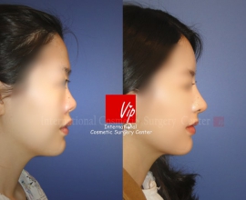 Ribcartilage rhinoplasty